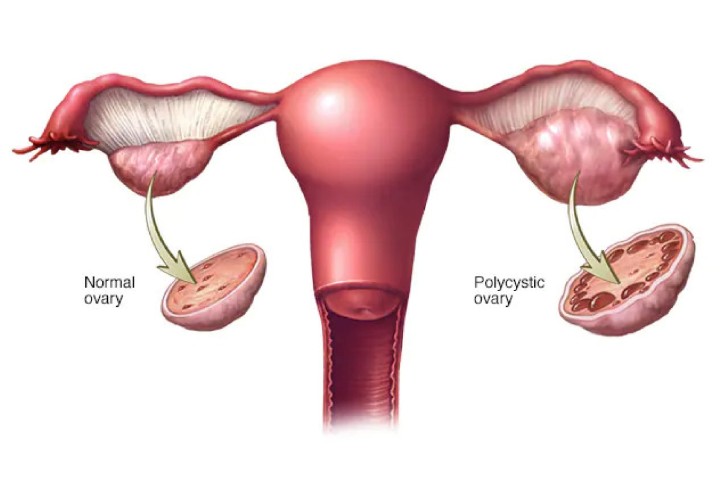 Kisspeptin levels in polycystic ovary syndrome & its manifestations