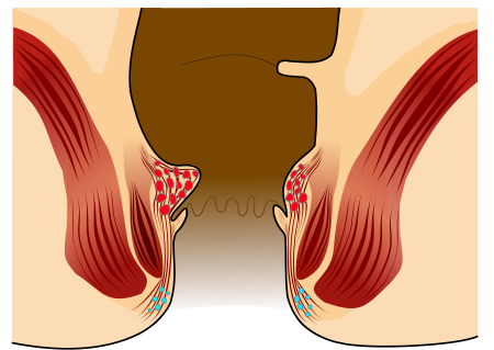 Perianal Fistula