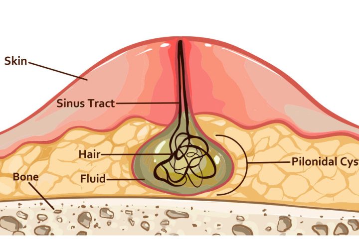 Pilonidal Sinus